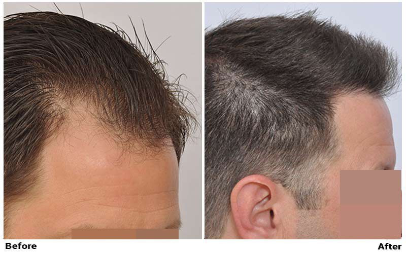 Hair Transplant 2201 grafts FUE