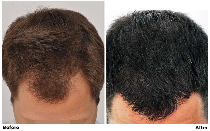 Hair Transplant 2201 grafts FUE