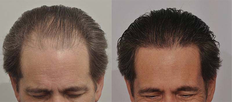 Hair Transplant 2701 grafts FUE hairline