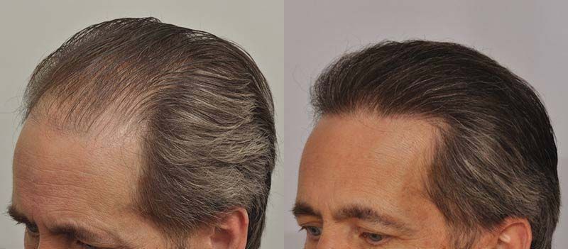 Hair Transplant 2701 grafts FUE left side