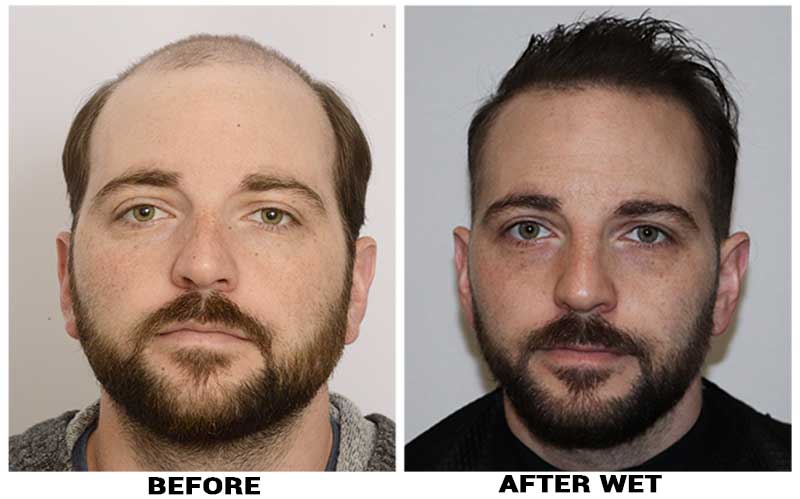Hair Transplant 9485 grafts FUE