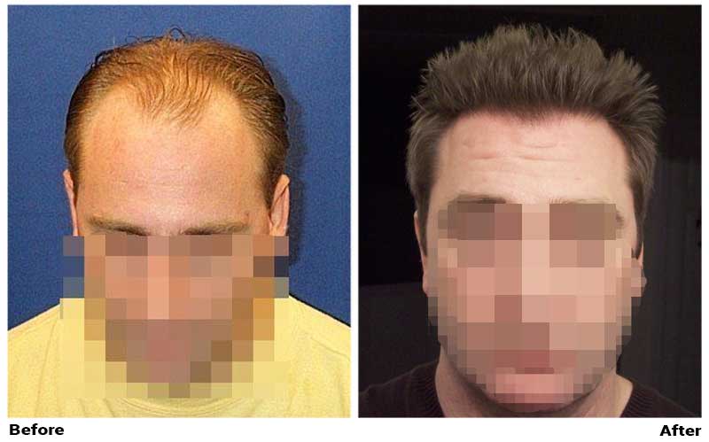 Hair Transplant 5600 grafts FUE
