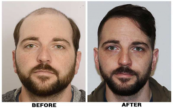 Hair Transplant 9485 grafts FUE