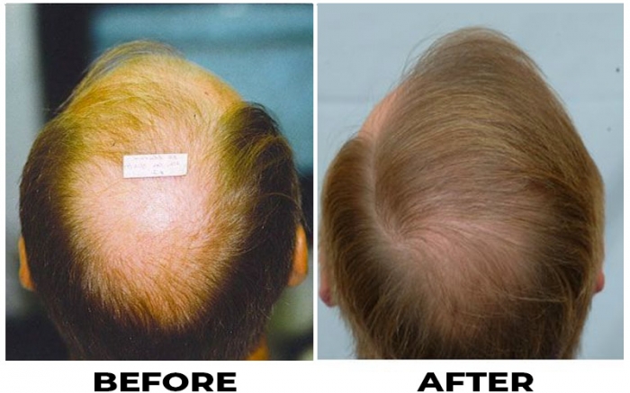 Hair Transplant 3650 grafts FUE & FUT