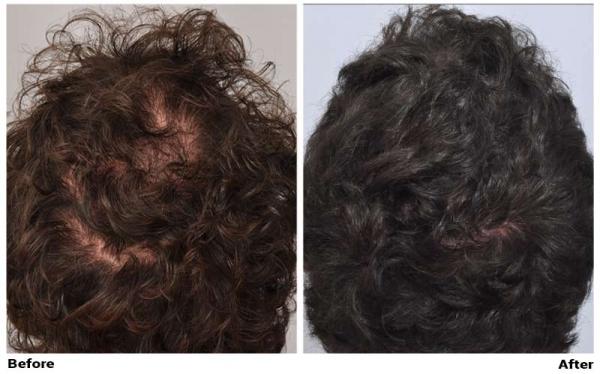Hair Transplant 515 grafts FUE