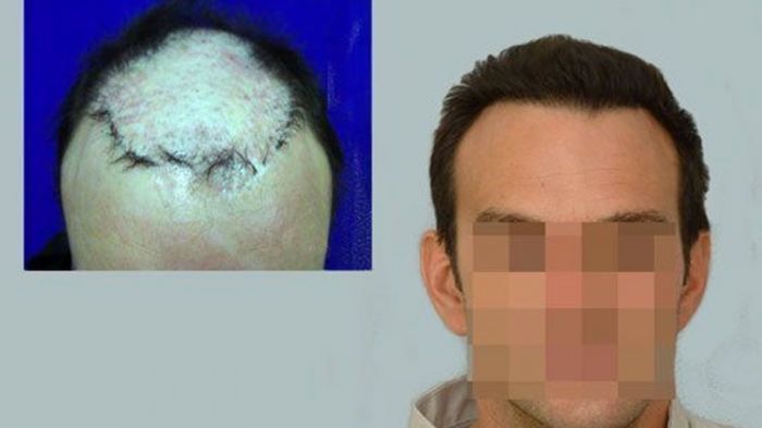 Scalp Repair 3951 grafts FUE