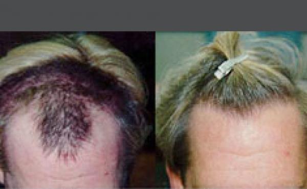 Hair Transplant 1500 grafts FUT