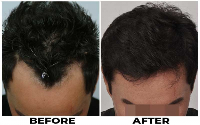 Hair Transplant 2055 grafts FUE