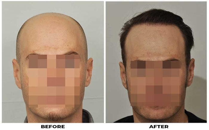 Hair Transplant 3605 grafts FUE
