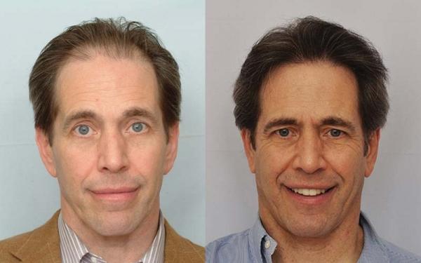 before-after-photos-hair-transplant-2701-grafts-fue