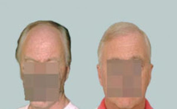 Hair Transplant 2000 grafts FUE