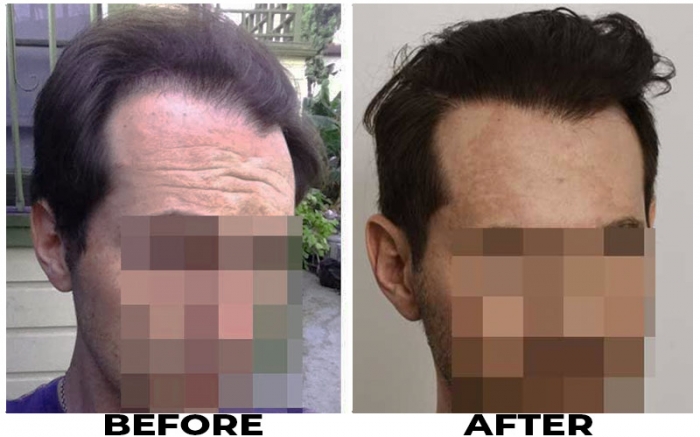Hair Transplant 2234 grafts FUE