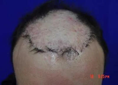 Before FUE repair procedure
