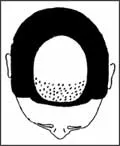 Woman Hair Loss Pattern