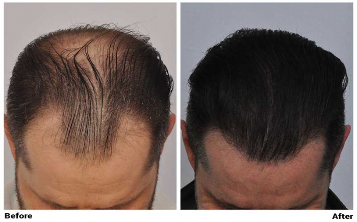 Patient OOO before & after FUE results featured photo