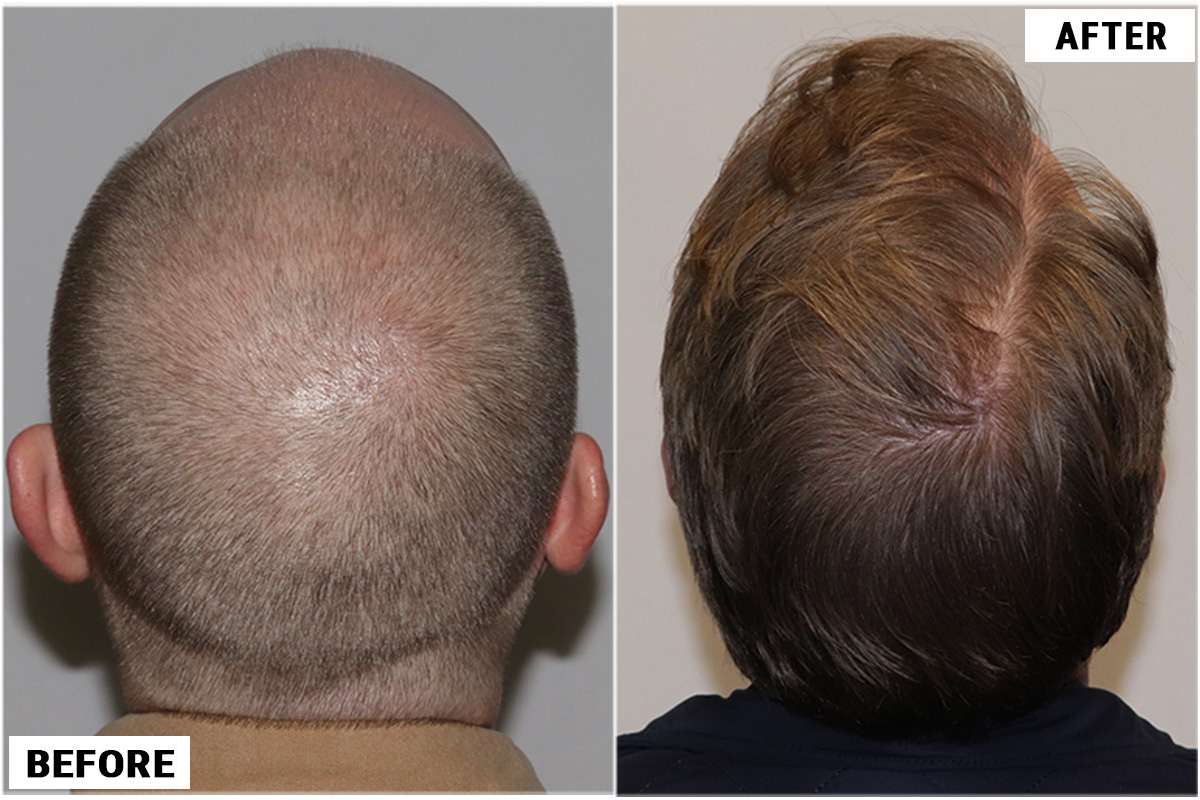 Hair Transplant 3123 grafts FUE