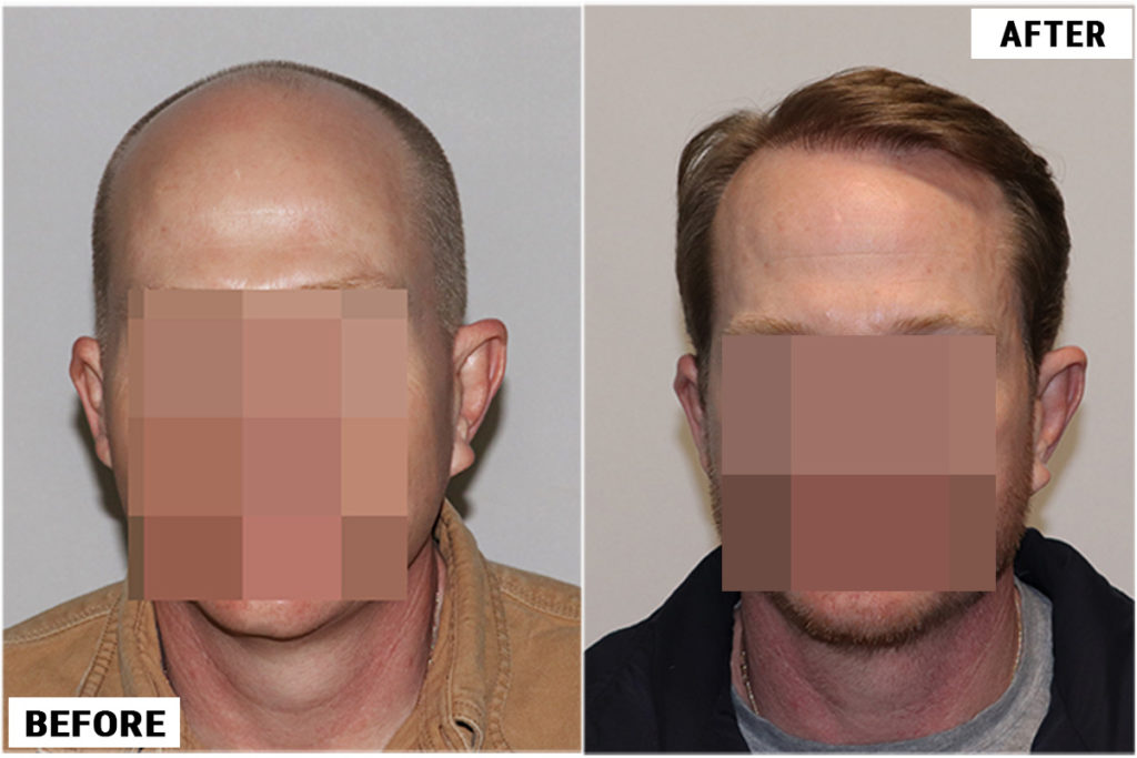 Hair Transplant 3123 grafts FUE