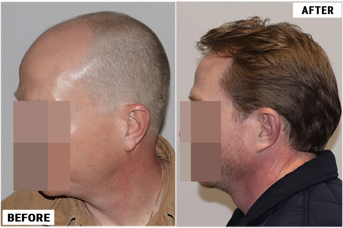Hair Transplant 3123 grafts FUE