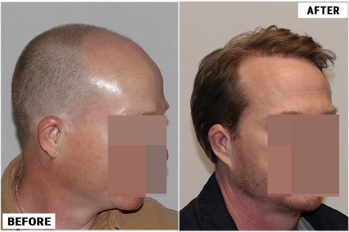Hair Transplant 3123 grafts FUE