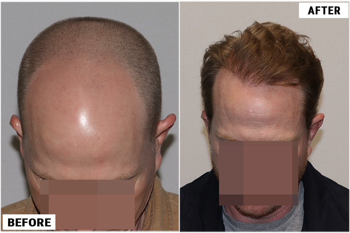 Hair Transplant 3123 grafts FUE