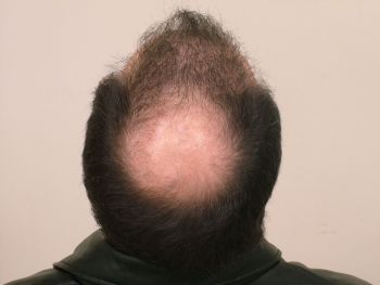 Before the hair transplant surgery