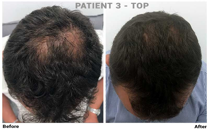 Dr. Cole Live: Anti-aging, Treatment Progress, and FUE Europe, Forhair