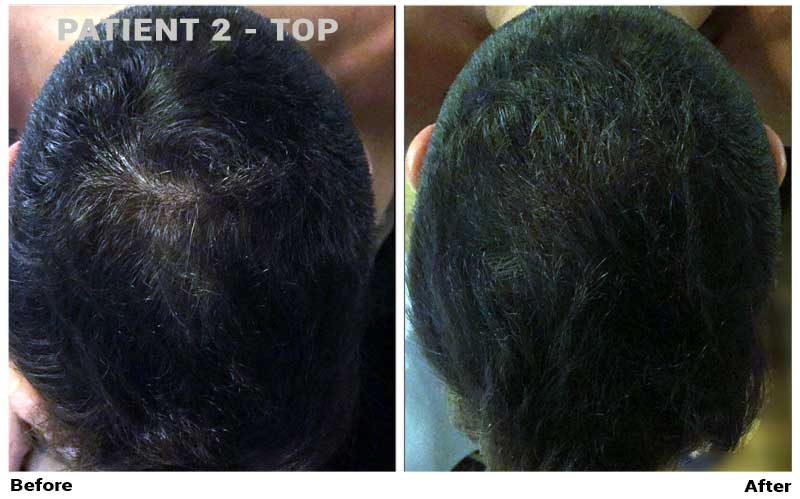 Dr. Cole Live: Anti-aging, Treatment Progress, and FUE Europe, Forhair