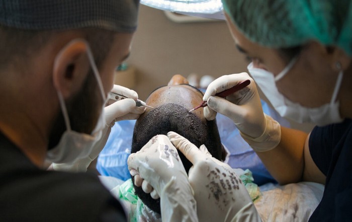 Scalp micro-pigmentation with hair restoration