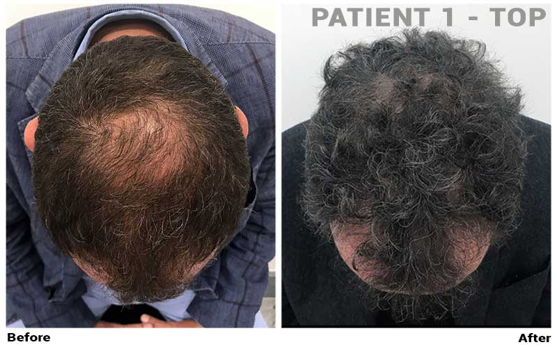 Dr. Cole Live: Anti-aging, Treatment Progress, and FUE Europe, Forhair
