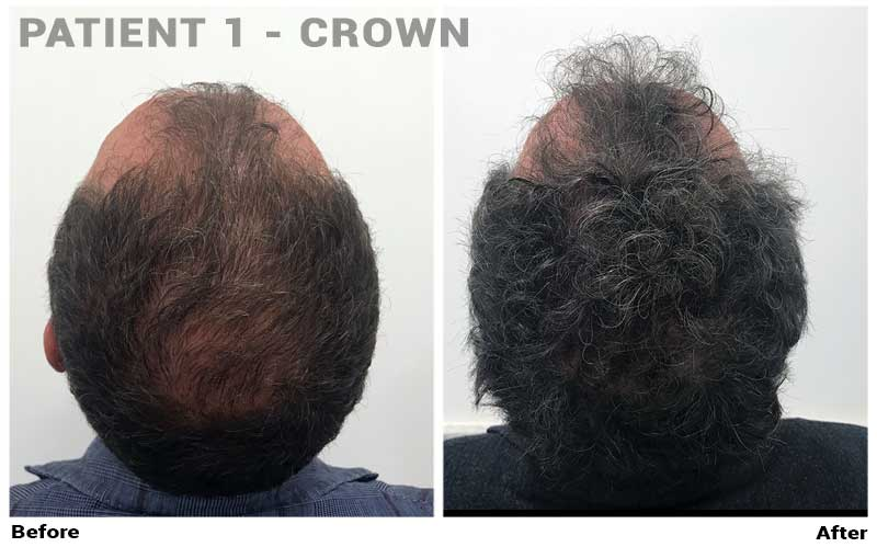 Dr. Cole Live: Anti-aging, Treatment Progress, and FUE Europe, Forhair