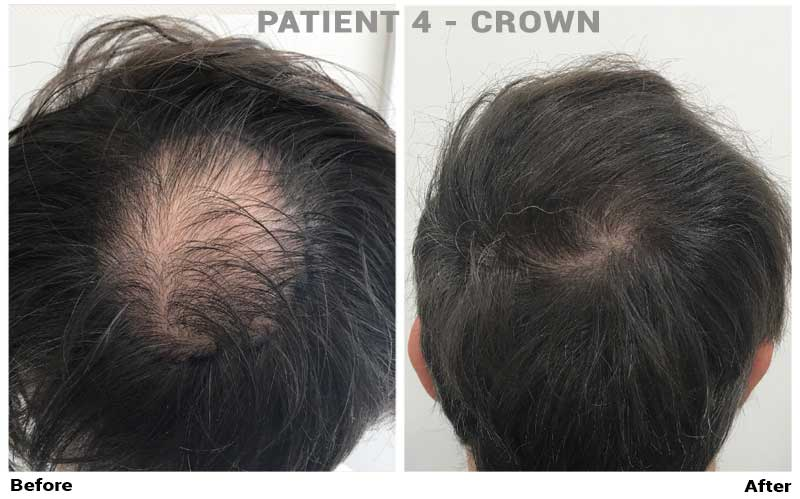 Dr. Cole Live: Anti-aging, Treatment Progress, and FUE Europe, Forhair