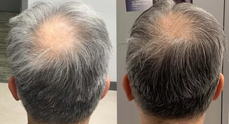 Male Hair Restoration Patient