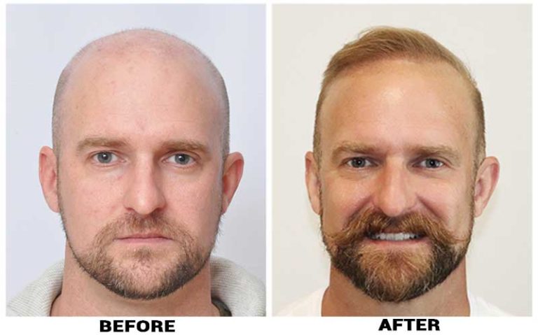 Hair Transplant 5582 grafts FUE