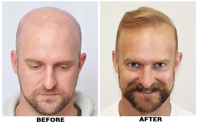 Hair Transplant 5582 grafts FUE