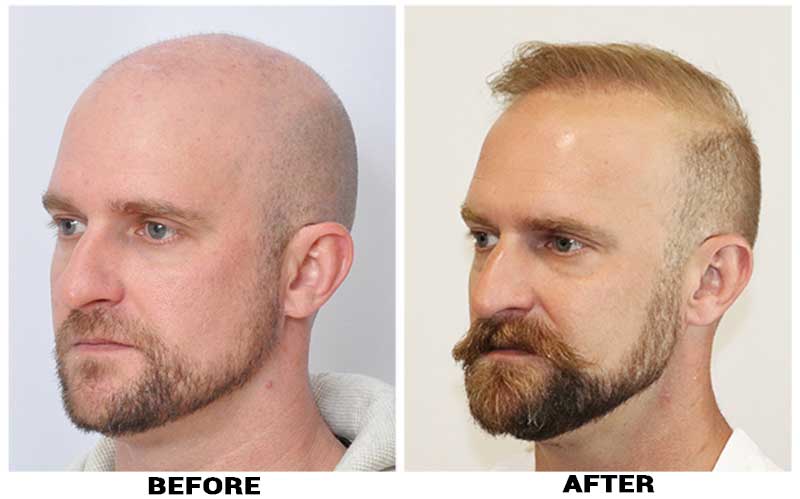 Hair Transplant 5582 grafts FUE