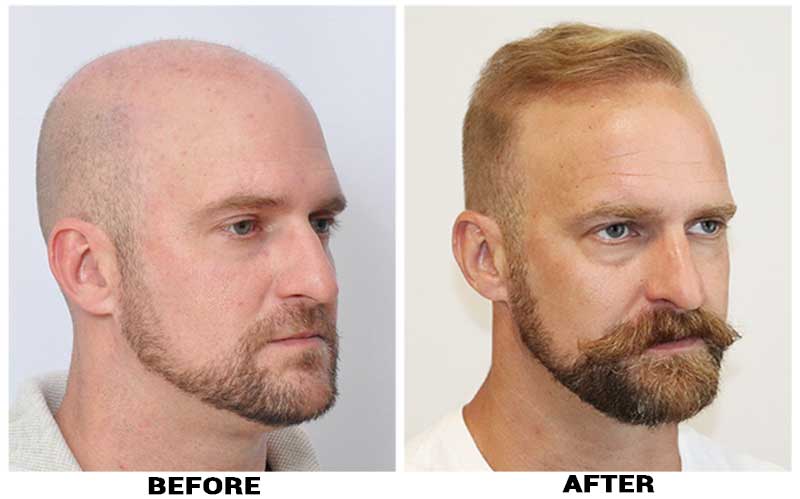 Hair Transplant 5582 grafts FUE