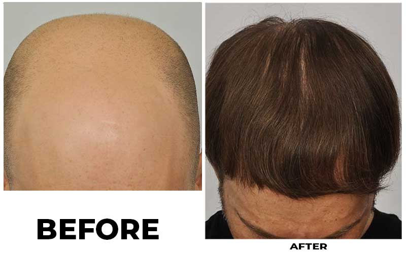 Hair Transplant 3605 grafts FUE