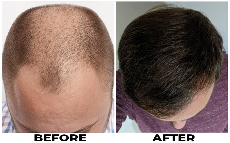 Hair Transplant 2833 grafts FUE