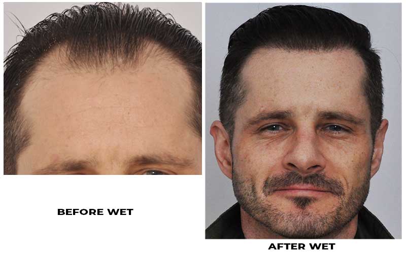 Hair transplant 3957 grafts FUE