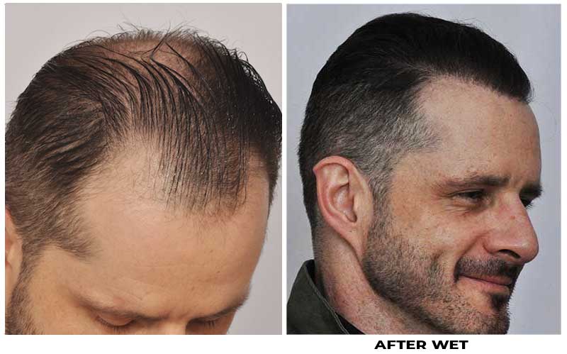 Patient OOO | Forhair Patient OOO | Forhair