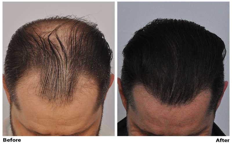 Hair Transplant 3957 grafts FUE