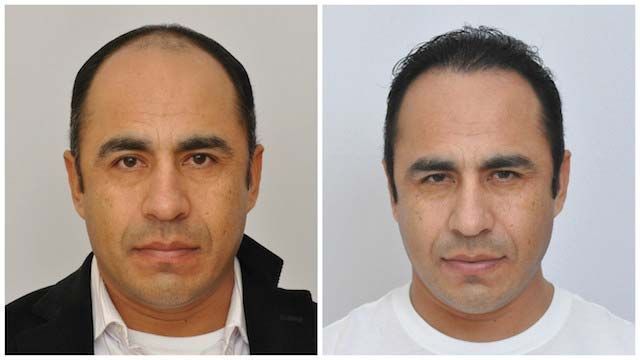 Hair Transplant 2500 grafts FUE