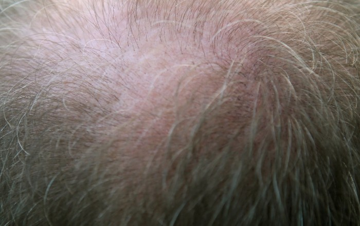 Pain is normal after hair restoration surgery, especially in the donor area, but it is a temporary condition that usually lasts a day or two and is something hair transplant patients need not worry about.