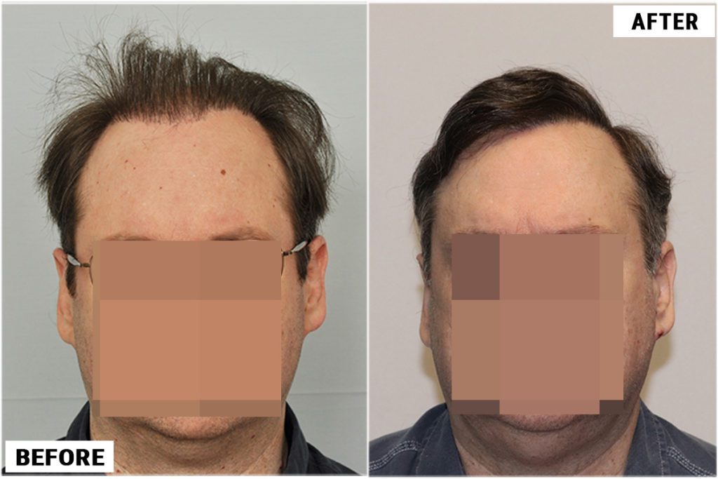 Scalp Repair 4800 grafts
