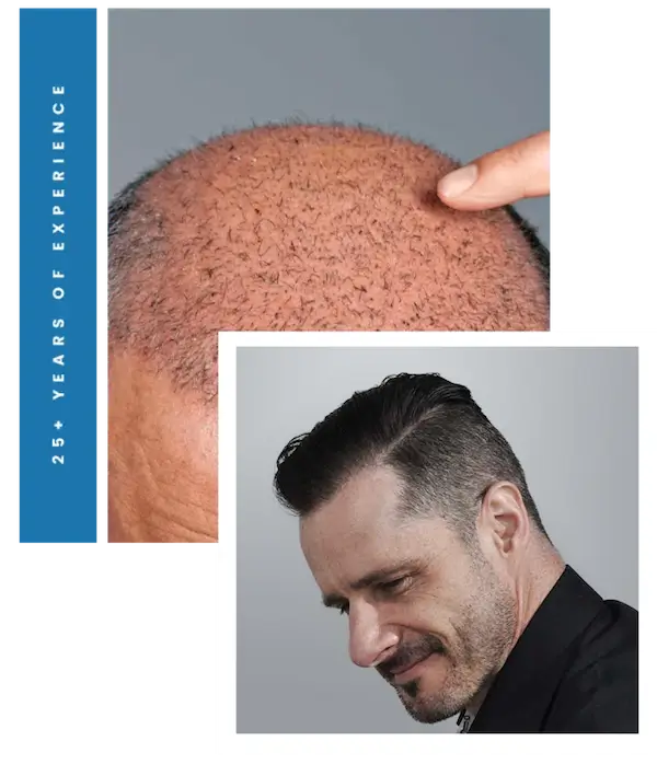 FUE Hair Transplant Pioneer Clinic