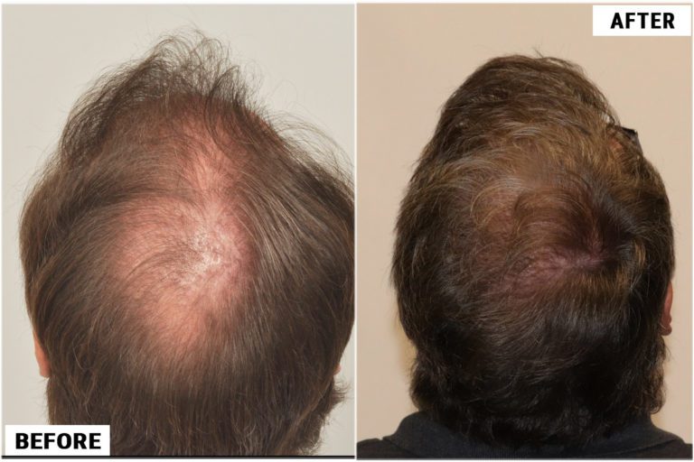 before-after-back