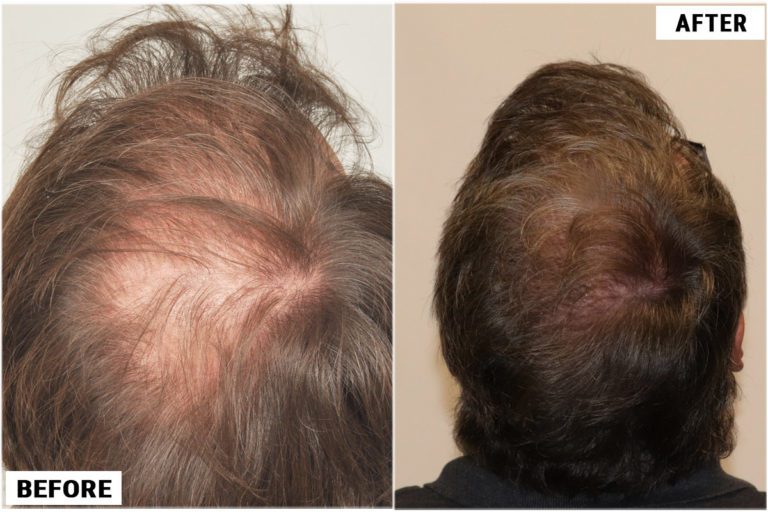 before-after-back2
