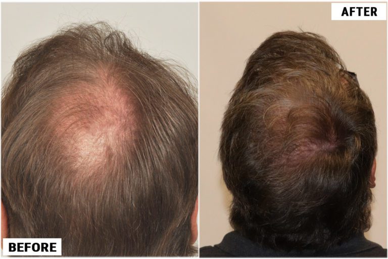before-after-back3