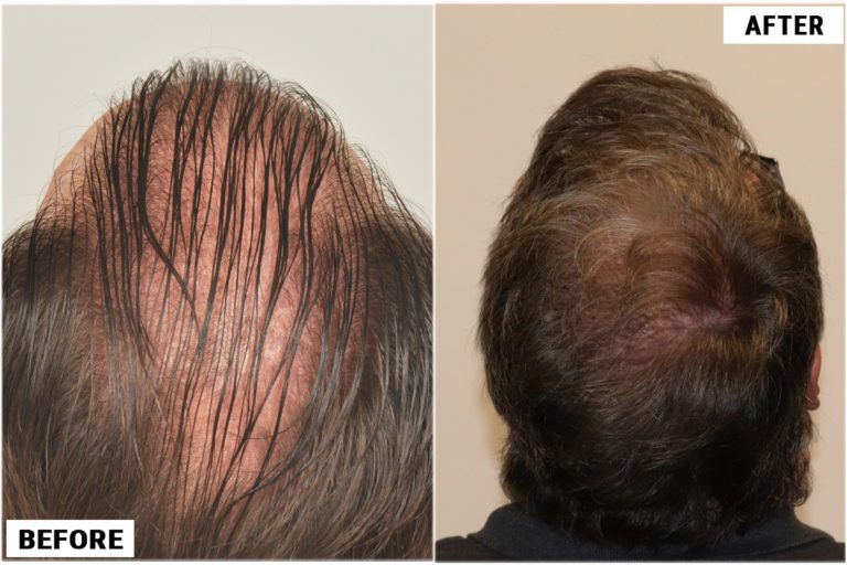 before-after-back4