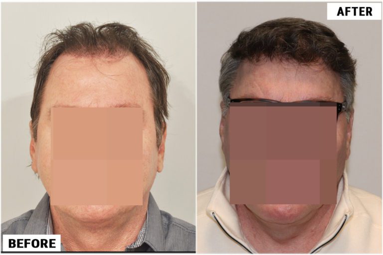 Patient BLB photos